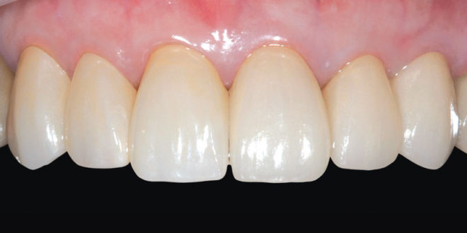 Zirconia crown / bridge - Dental crowns for new tooth: Zirconium pros ...