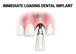 Immediate loading implants, also known as basal implants