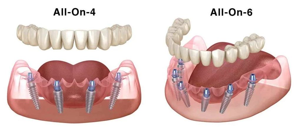 Close-up illustration of All-on-4 vs All-on-6 full-arch dental implant bridges, highlighting implant positions in the jawbone at a Budapest dental clinic treating international patients.